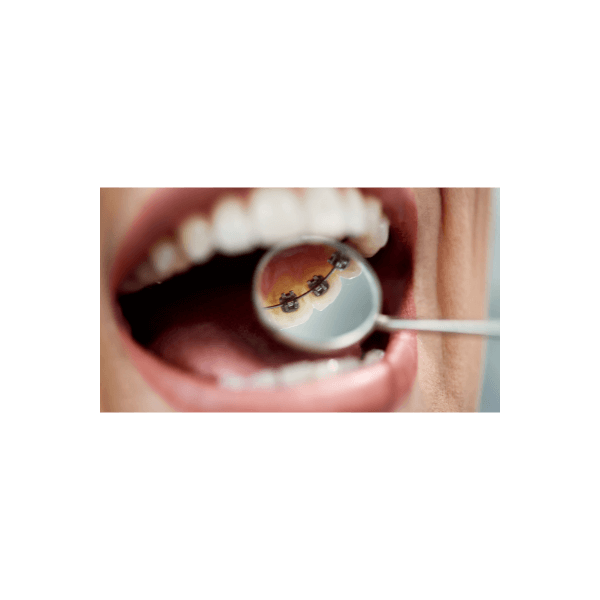 舌側牙套