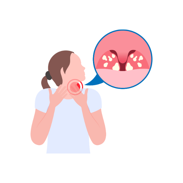 喉嚨發炎插圖