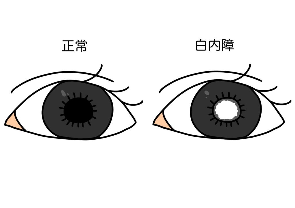正常眼睛和白內障的比較