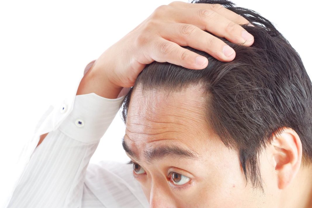 關心額頭髮際線的中年男人