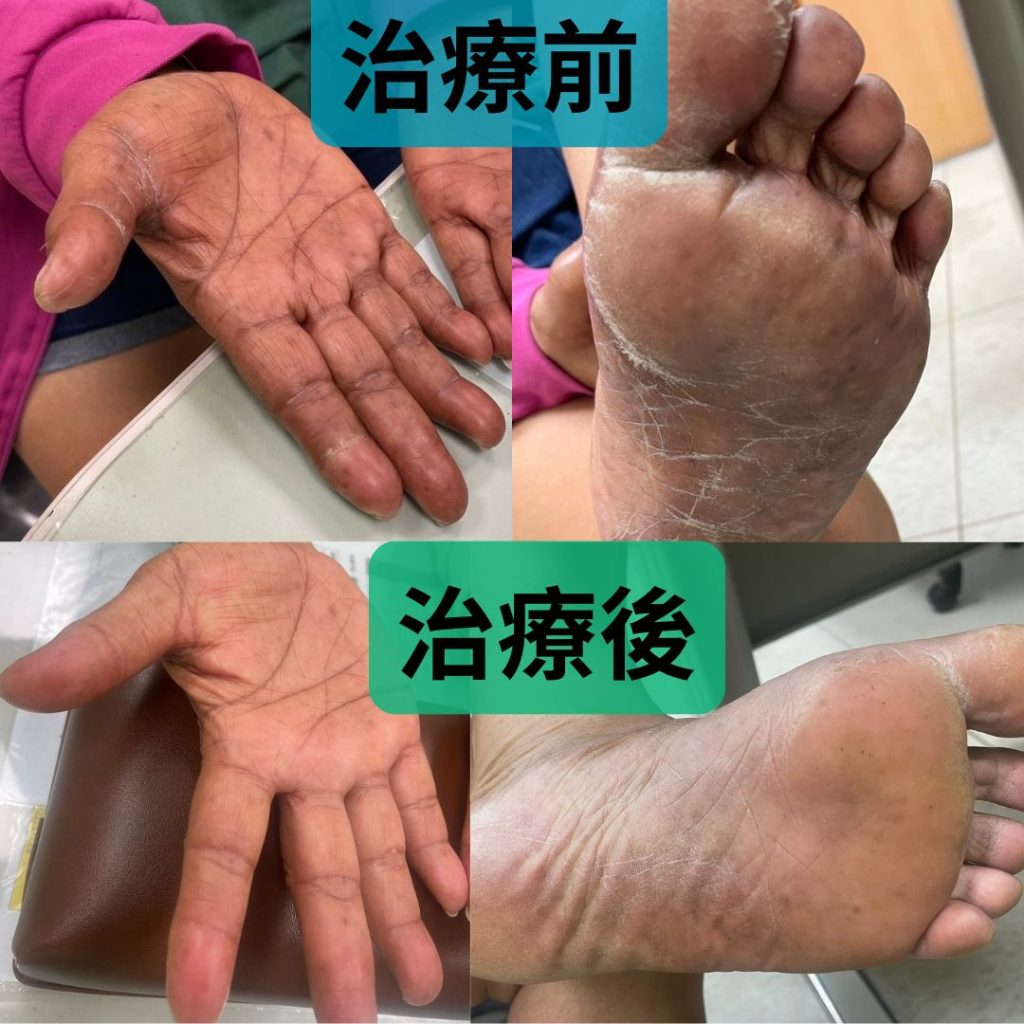 透過中醫輔助治療,有助緩解癌症病人手足紅腫疼痛的不適