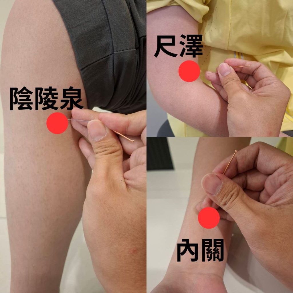 常用針灸穴位如尺澤穴、內關穴、陰陵泉穴...等。針灸屬自然恢復方式，對於症狀仍在早期、擔心手術風險或偏好保守治療的民眾相當適合。