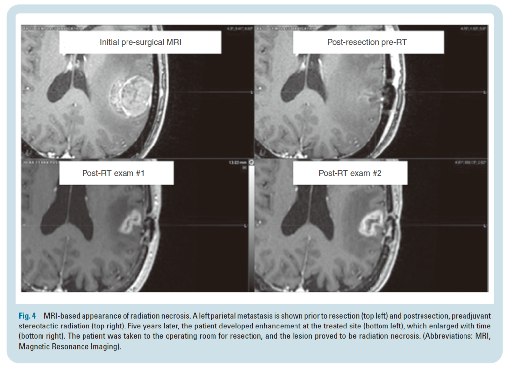 腦轉移病灶在手術與放射治療前後的 MRI 變化，顯示治療後局部增強影像隨時間出現並最終證實為放射性壞死