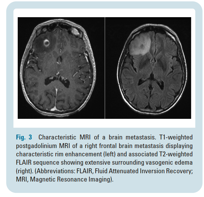 腦轉移腫瘤的 MRI 影像示意，顯示右額葉病灶在 T1 加顯呈現環狀增強，並於 FLAIR 影像中可見明顯周邊血管性水腫
