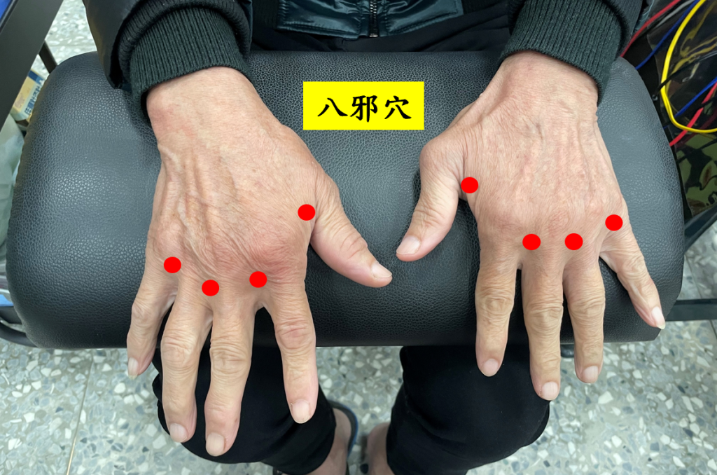 針灸「八邪穴」能有效疏通經絡、促進血液循環,緩解關節腫脹與僵硬。